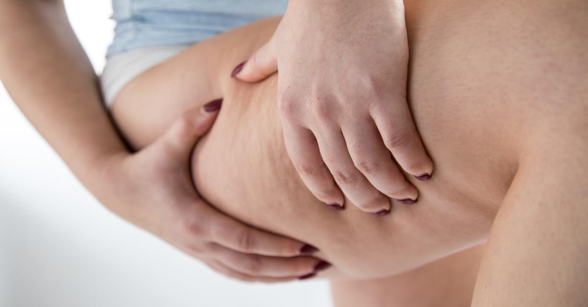 New decision on lipedema gives those affected hope