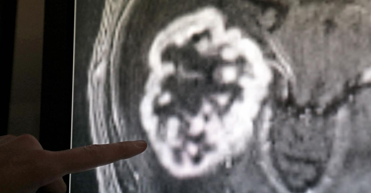 Lungentumore-sind-bei-Frauen-und-M-nnern-h-ufigster-Krebstod