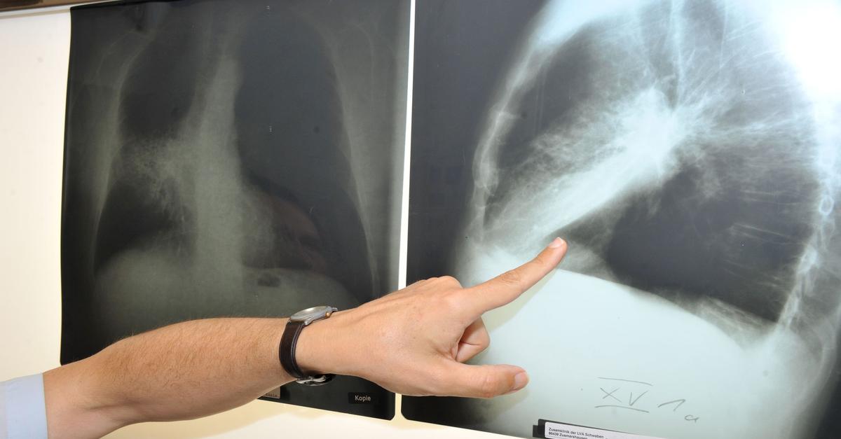 Lungenkrebs-durch-Radon-Belastung-derzeit-besonders-hoch